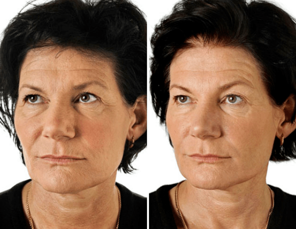 Το αποτέλεσμα της κλασματικής αναζωογόνησης του προσώπου