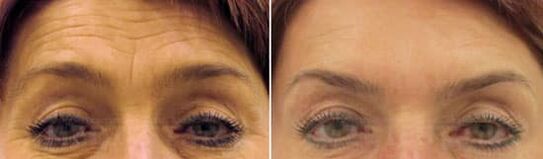 Αναζωογόνηση πεδίου του μέτωπο